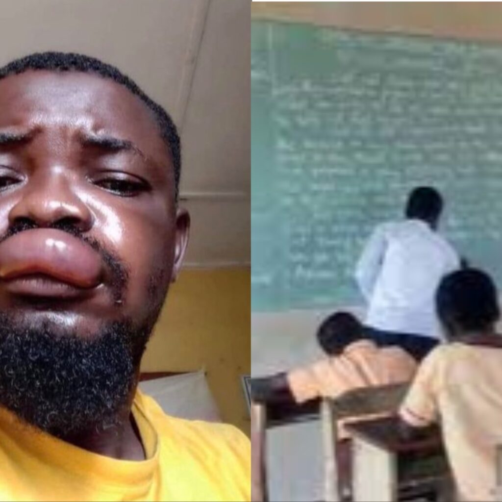 Face Of Mathematics Teacher Who Continued Preparing His Students For Exam After Being Stung By Bee