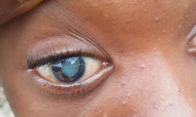 13- year-old girl disfigured by guardian in Imo to undergo surgery
