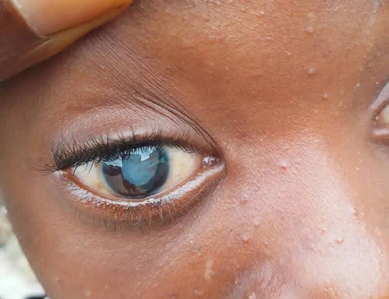 13- year-old girl disfigured by guardian in Imo to undergo surgery
