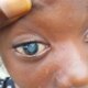 13- year-old girl disfigured by guardian in Imo to undergo surgery